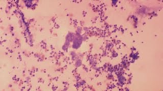 WHO claims 37 billion people infected with herpes virus [upl. by Kcirdled]