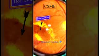 Diabetic Retinopathy  CSME  Retina  Short Video 170 akleshkumar optometrist [upl. by Wilde146]