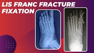 LISFRANC FRACTURE FIXATION IN A YOUNG MALE ASSOCIATED WITH MULTIPLE METATARSAL FRACTURES [upl. by Alleuqcaj55]