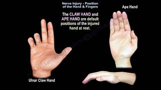 Nerve Injury Position of the Hand amp Fingers  Everything You Need To Know  Dr Nabil Ebraheim [upl. by Hax]