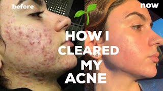 HOW I CLEARED MY CYSTIC ACNE NATURALLY  TIPS NO ACCUTANE [upl. by Clevie87]