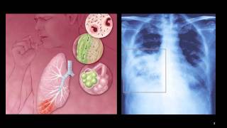 Atypical Pneumonia [upl. by Meesaw131]