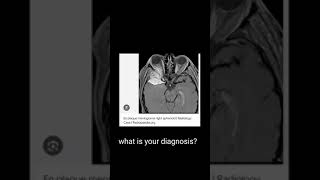 meningiomawhat u should check [upl. by Nnayrrehs]