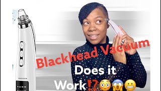 PoreBlackhead Remover Vacuum Do they work Freeshow blackhead remover 2022 Review [upl. by Eteragram608]