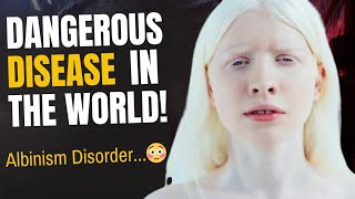 The Albinism Disorder  Dangerous or Normal   HindiUrdu  AR Research [upl. by Aneehsal109]