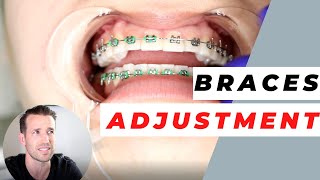 Orthodontist Explains Monthly Adjustments  Monthly Visits [upl. by Sandry]