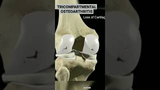 Tricompartmental Osteoarthritis kneeosteoarthritisosteoarthritis kneepainphysicaltherapyanatomy [upl. by Alberic888]