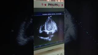 2D ECHO  EF 38  LV GLOBAL HYPOKINESIA DILATED LV LA RA [upl. by Peatroy]