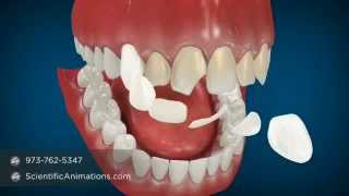 Cosmetic Dentistry Procedures  Dental Animation [upl. by Myranda844]