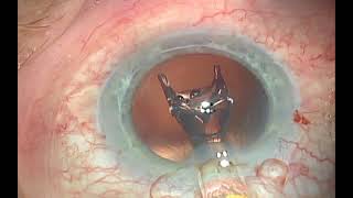 Capsulefixated Intraocular Lens Implantation 2018 [upl. by Marigold]