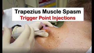 Trapezius Muscle Spasm Trigger Point Injection [upl. by Emmalyn38]