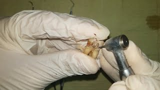 Management of deep caries using partial caries removal technique practical عربي [upl. by Perusse]