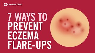 7 Ways to Prevent Eczema FlareUps [upl. by Notnyw499]