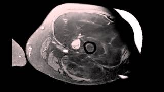 Well differentiated Liposarcoma Left Thigh [upl. by Esekram961]