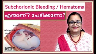 Subchorionic HematomaBleeding In Pregnancy What Is It Should You Be Afraidഎന്താണ്പേടിക്കണോMBT [upl. by Ttayh]