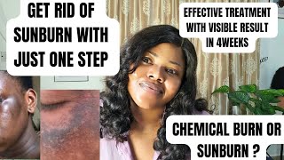 HOW TO GET RID OF SUNBURN CHEMICAL BURNS AND MELASMA WITH JUST ONE SIMPLE STEP melasma skincare [upl. by Ylera363]