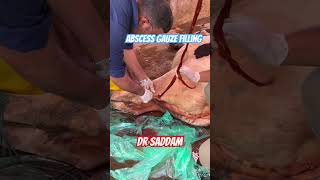 Abscess gauze filling love by Dr Saddam [upl. by Ailedamla]