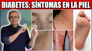 10 SINTOMAS de DIABETES en la PIEL [upl. by Middlesworth]