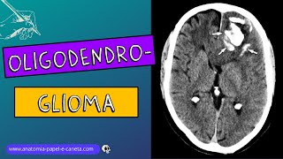 Oligodendroglioma [upl. by Barney]