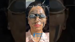 Laser Carbon peel for Dull skin pigmented Acne scarsampuneven skin tone olimpiacarmen hollywoodpeel [upl. by Aleirbag]