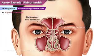 Acute Bacterial Rhinosinusitis ABRS  ENT Lectures [upl. by Nunci704]