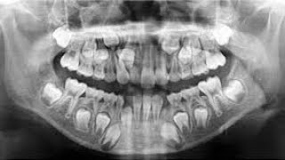 DIENTES SUPERNUMERARIOS  HIPERDONCIA  ANOMALÍAS DENTALES  ODONTOLOGÍA [upl. by Romulus]