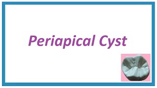 Periapical Cyst or Radicular Cyst  Important Notes  Cysts of Orofacial region 2  Oral Pathology [upl. by Hieronymus]