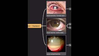 MiniMap Acute Red Eye  Hypopyon Pus in the Anterior Chamber [upl. by Atonsah]