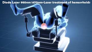 Laser Hemorrhoidoplasty LHP  IBI Healthcare Institute [upl. by Kancler]