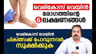 വെരികോസ് വെയിൻ രോഗത്തിന്റെ 6 ലക്ഷണങ്ങൾ  Varicose veins Malayalam Video [upl. by Gayelord]