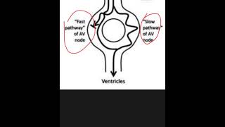 Pseudo S amp Pseudo R waves of AVNRTa result of PAC conducting down slow pathway discussion on ECG [upl. by Anehsuc]