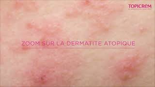 Tout Savoir sur la Dermatite Atopique [upl. by Arluene]