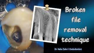 How to Remove a Separated Instrument Using Ultrasonics [upl. by Ahter]