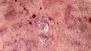 Satisfying Relaxing with Vien Tham My DrAZI vienthammydrazi0151 acne pimples blackheads [upl. by Maltzman]