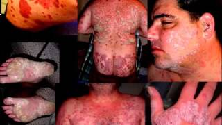 Stelara Side Effects Stelara causes drug induced psoriasis Biologic problems big Eng subtitles [upl. by Yddor]