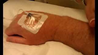 IVIG Infusion Procedure part 2  Treatment for Stiff Person Syndrome [upl. by Plante]