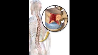 multiple bony lytic lesions [upl. by Melmon]