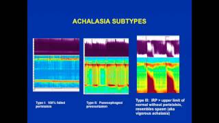 Achalasia is the esophageal motility abnormality [upl. by Adnilram]