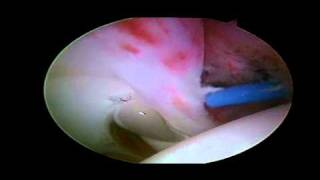 Labral Tear  Detached Anterior Labrum [upl. by Aihsi164]