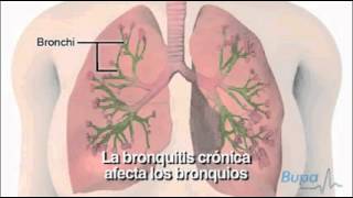 Enfermedad pulmonar obstructiva crónica EPOC [upl. by Crooks]