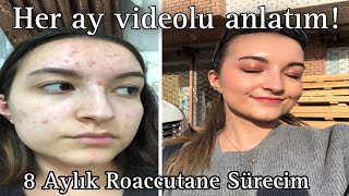 SİVİLCE TEDAVİM  Her Ay Videosunu Çektiğim 8 Aylık Roaccutane Sürecim [upl. by Arreip]