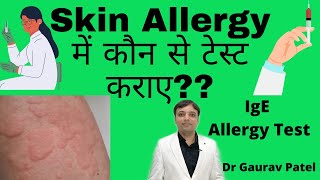 Test in skin allergy in Hindi  स्किन ऐलर्जी में कौन से रिपोर्ट कराए SIgE amp Allergy test [upl. by Chirlin]