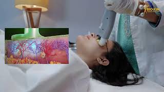 Acne Gold Laser Therapy ব্রণের সমস্যার সমাধান করুন প্রিমিয়াম উপায়ে একনি গোল্ড লেজার থেরাপির মাধ্যমে [upl. by Crean]