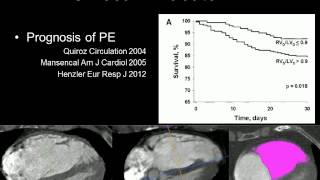 Pulmonary embolism echo in all [upl. by Cirenoj]