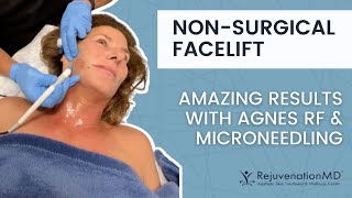 Safe Nonsurgical Facelift with Agnes RF Microneedling for TIGHT amp SCULPTED Skin [upl. by Eeliak]