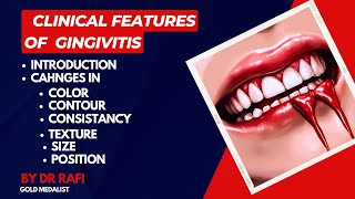 Clinical Features Of Gingivitis  Periodontology Lecture [upl. by Anilok407]