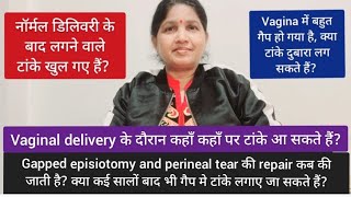 नॉर्मल डिलिवरी के बाद टांके खुल गए हैं । Gapped episiotomy और perineal tear repair कब की जाती है [upl. by Greabe151]