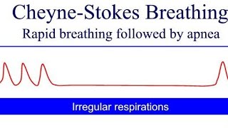 Cheyne Stokes Breathing Pattern  general diseases in human body Cheyne Stokes Kussmauls Biots [upl. by Mungovan]