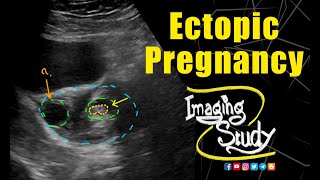 Live Ectopic Pregnancy  Ultrasound  Case 140 [upl. by Auqkinahs744]