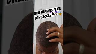 Hair Loss After Dreadlocks  Traction Alopecia👀 alopeciajourney [upl. by Aray676]